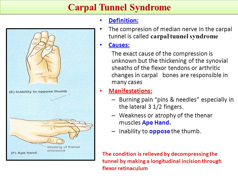 How to Prevent Carpal Tunnel Syndrome